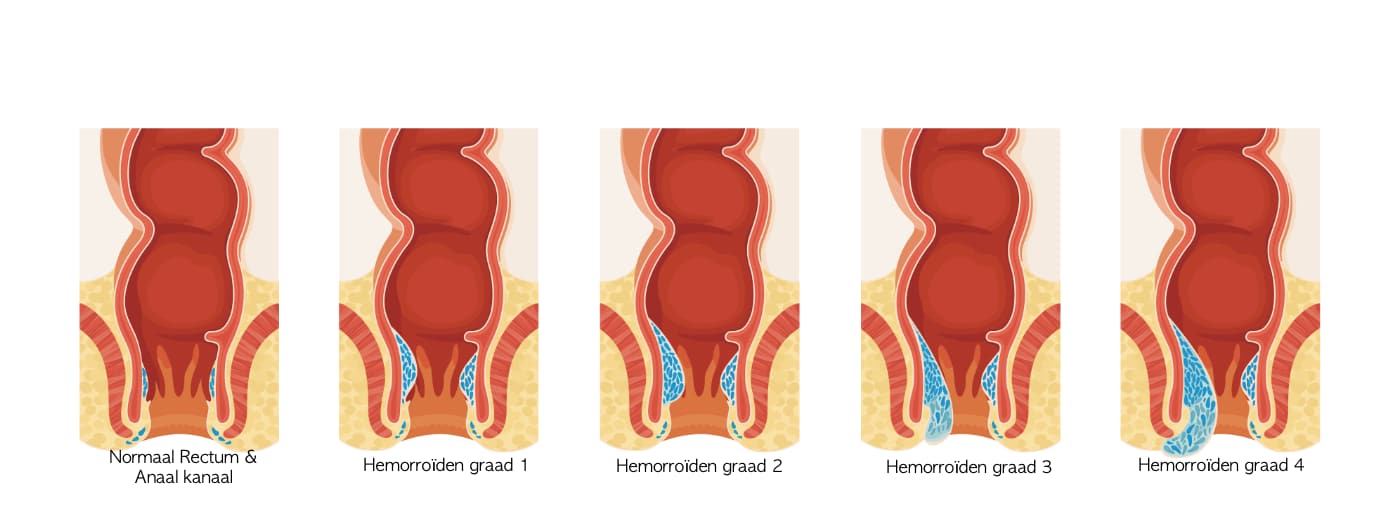 Chirurgisch Centrum Maastricht | Aambei klachten? | Wordt direct geholpen!